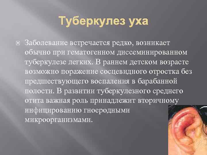 Туберкулез уха Заболевание встречается редко, возникает обычно при гематогенном диссеминированном туберкулезе легких. В раннем