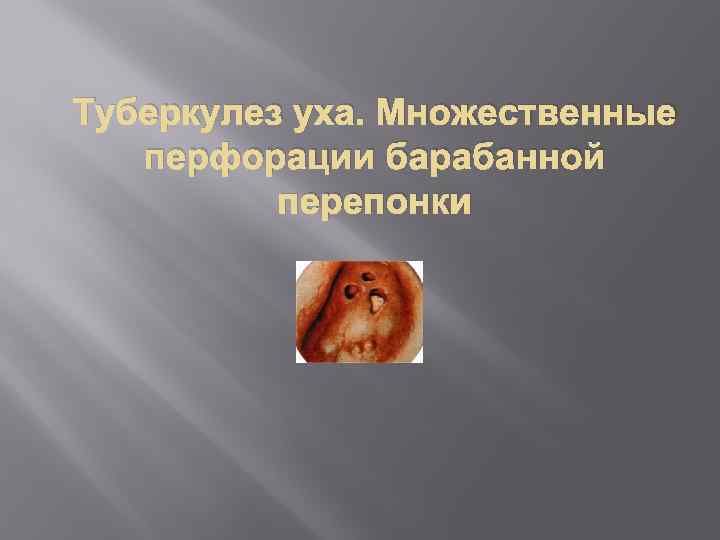 Туберкулез уха. Множественные перфорации барабанной перепонки 