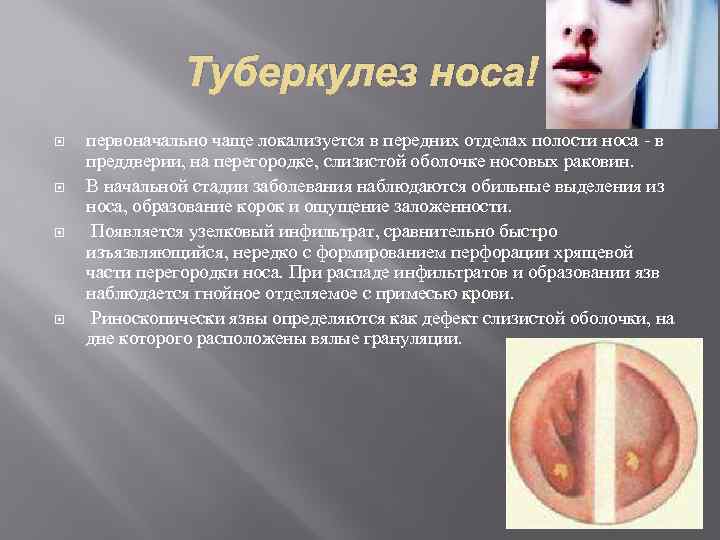 Туберкулез носа первоначально чаще локализуется в передних отделах полости носа - в преддверии, на
