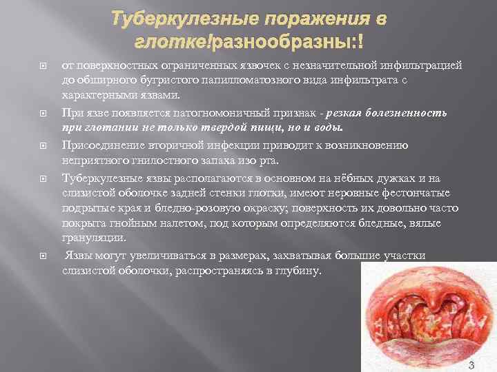 Туберкулезные поражения в глотке разнообразны: от поверхностных ограниченных язвочек с незначительной инфильтрацией до обширного
