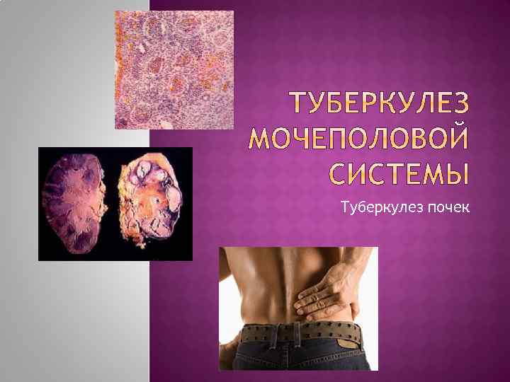 Туберкулез почек 