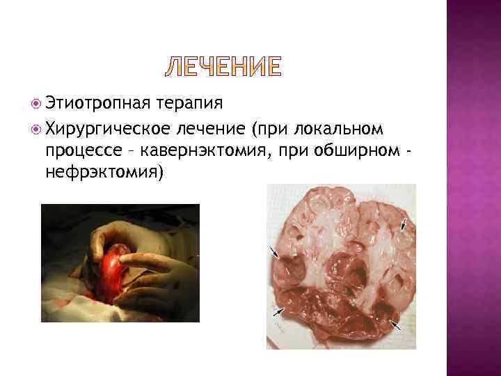  Этиотропная терапия Хирургическое лечение (при локальном процессе – кавернэктомия, при обширном нефрэктомия) 