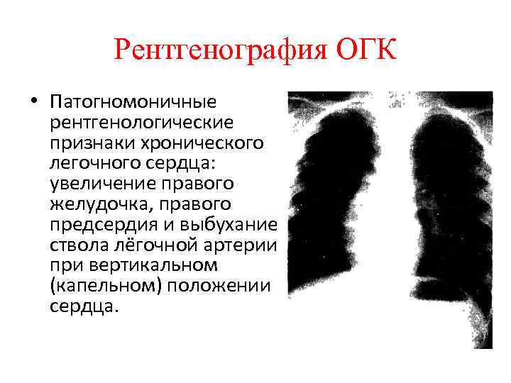 Рентгенография ОГК • Патогномоничные рентгенологические признаки хронического легочного сердца: увеличение правого желудочка, правого предсердия