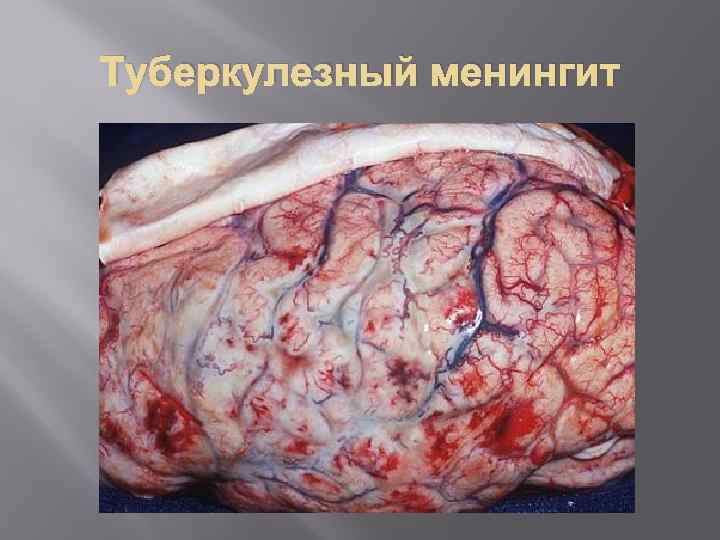 Туберкулезный менингит презентация