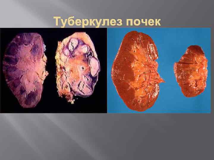 Туберкулез почек 