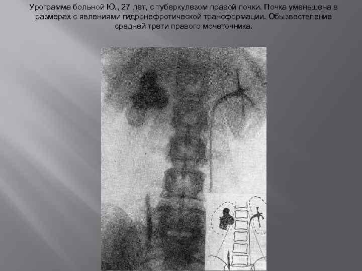 Урограмма больной Ю. , 27 лет, с туберкулезом правой почки. Почка уменьшена в размерах