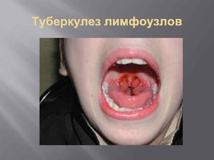 Туберкулез лимфоузлов 