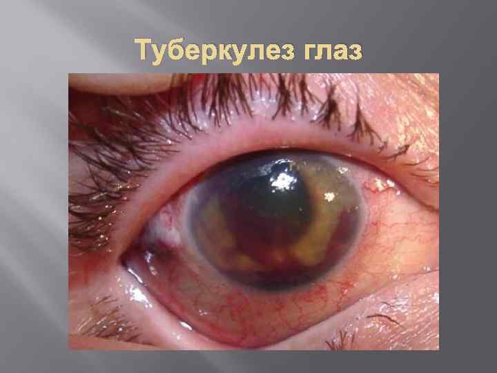 Туберкулез глаз 