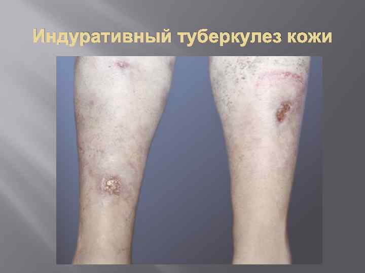 Индуративный туберкулез кожи 