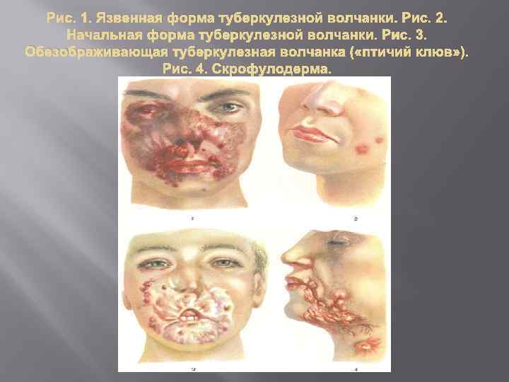 Рис. 1. Язвенная форма туберкулезной волчанки. Рис. 2. Начальная форма туберкулезной волчанки. Рис. 3.