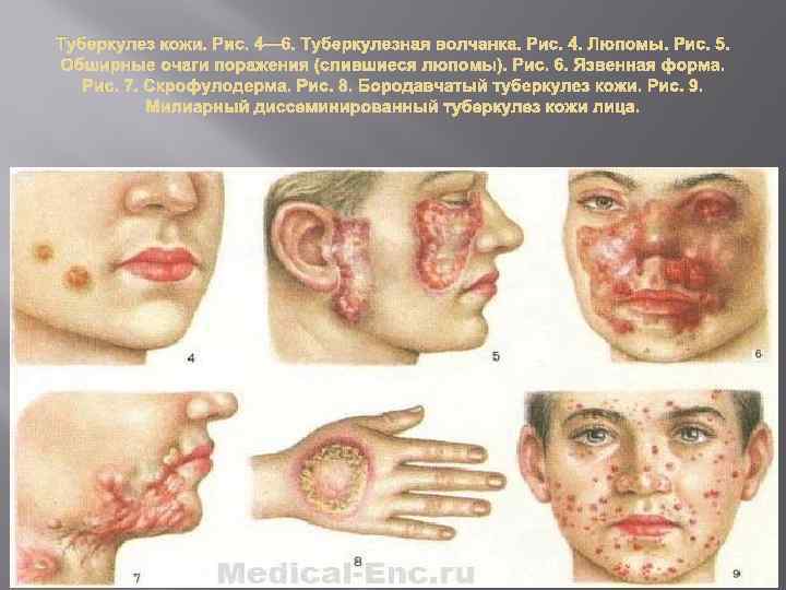 Туберкулез кожи. Рис. 4— 6. Туберкулезная волчанка. Рис. 4. Люпомы. Рис. 5. Обширные очаги