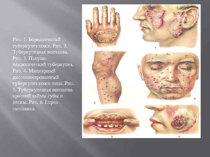 Рис. 1. Бородавчатый туберкулез кожи. Рис. 2. Туберкулезная волчанка. Рис. 3. Папулонекротический туберкулез. Рис.