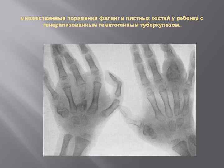 множественные поражения фаланг и пястных костей у ребенка с генерализованным гематогенным туберкулезом. 