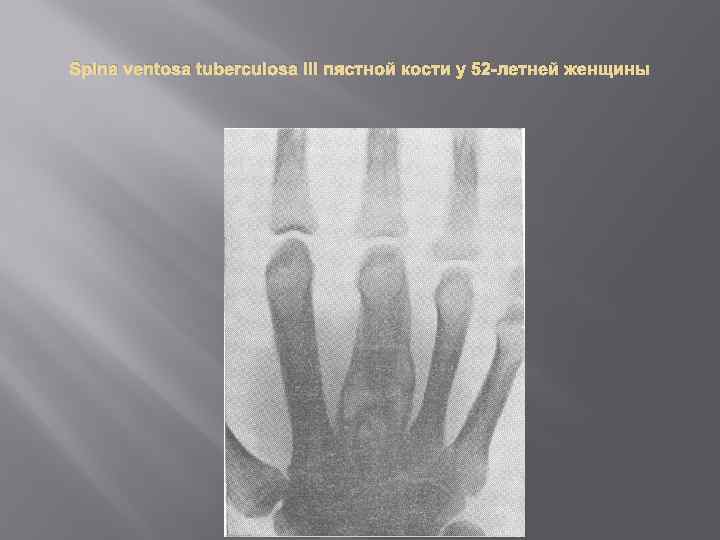 Spina ventosa tuberculosa III пястной кости у 52 -летней женщины 