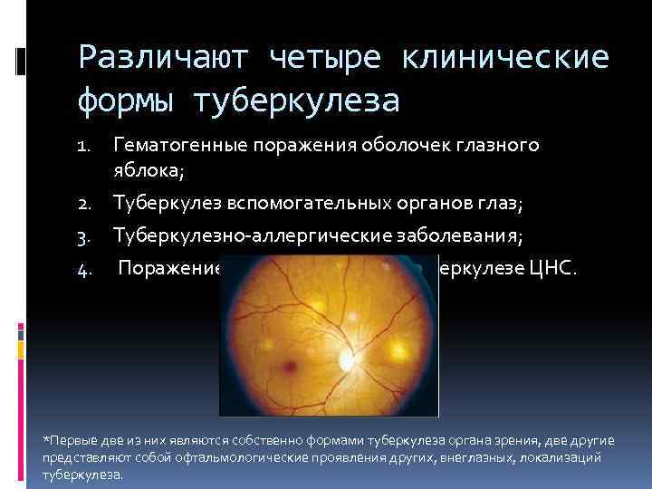 Различают четыре клинические формы туберкулеза Гематогенные поражения оболочек глазного яблока; 2. Туберкулез вспомогательных органов
