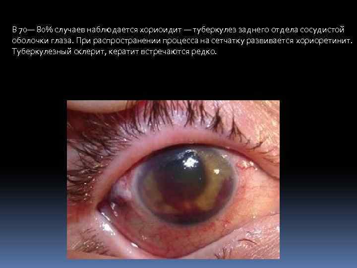 В 70— 80% случаев наблюдается хориоидит — туберкулез заднего отдела сосудистой оболочки глаза. При