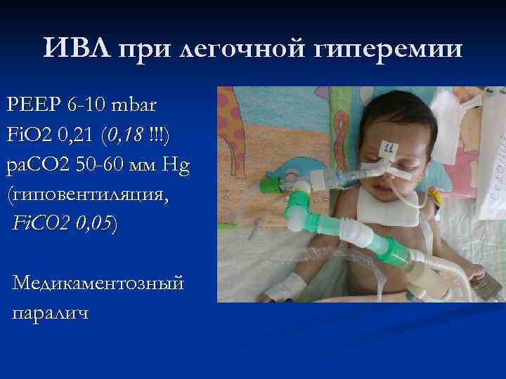 ИВЛ при легочной гиперемии РЕЕР 6 -10 mbar Fi. O 2 0, 21 (0,