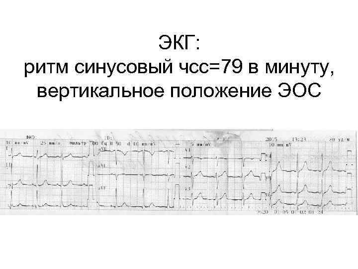 ЭКГ: ритм синусовый чсс=79 в минуту, вертикальное положение ЭОС 