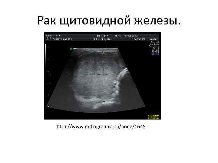 Рак щитовидной железы. http: //www. radiographia. ru/node/1645 