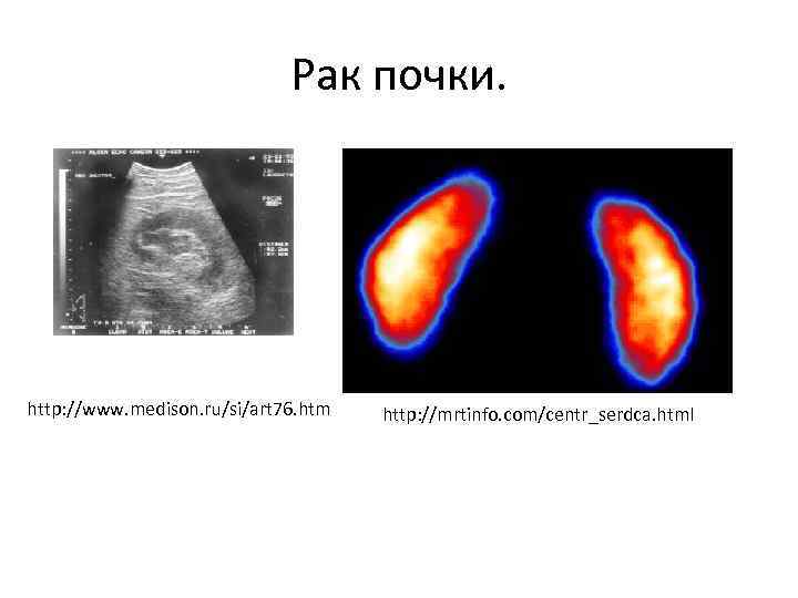 Рак почки. http: //www. medison. ru/si/art 76. htm http: //mrtinfo. com/centr_serdca. html 