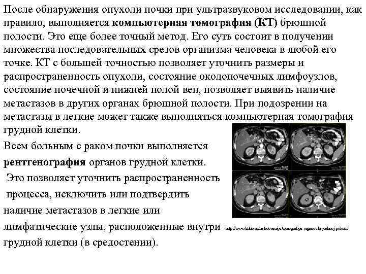 После обнаружения опухоли почки при ультразвуковом исследовании, как правило, выполняется компьютерная томография (КТ) брюшной