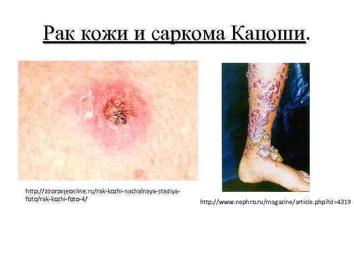 Рак кожи и саркома Капоши. Рак кожи и саркома Капоши http: //zdorovjeonline. ru/rak-kozhi-nachalnaya-stadiyafoto/rak-kozhi-foto-4/ http: