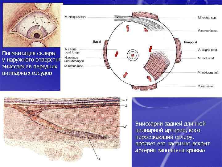 Пигментация склеры у наружного отверстия эмиссариев передних цилиарных сосудов Эмиссарий задней длинной цилиарной артерии,