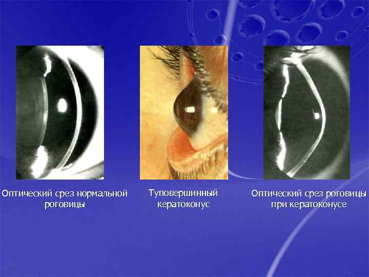 Оптический срез нормальной роговицы Туповершинный кератоконус Оптический срез роговицы при кератоконусе 