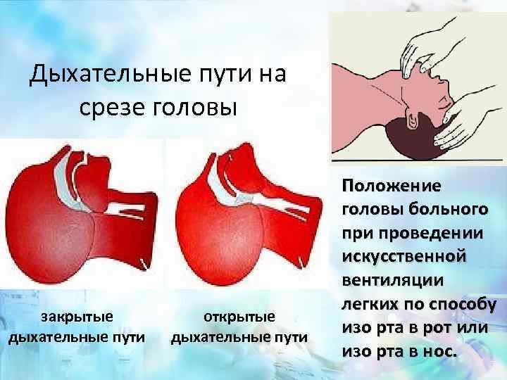 Дыхательные пути на срезе головы закрытые дыхательные пути открытые дыхательные пути Положение головы больного