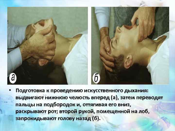  • Подготовка к проведению искусственного дыхания: выдвигают нижнюю челюсть вперед (а), затем переводят
