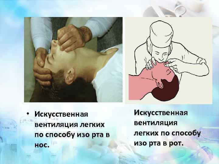  • Искусственная вентиляция легких по способу изо рта в нос. Искусственная вентиляция легких