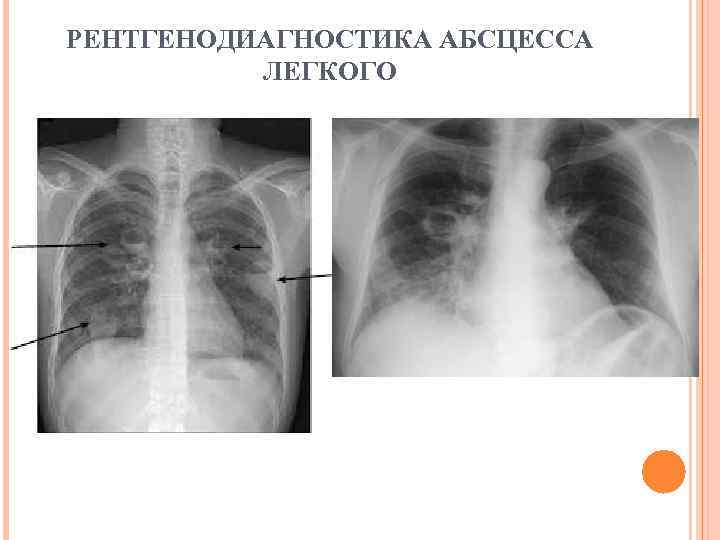 Лучевая картина абсцесса легких