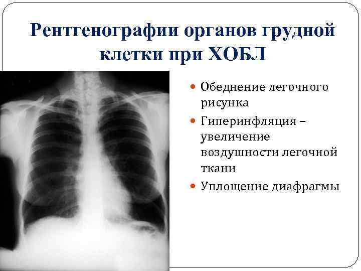 Хобл рентген картина