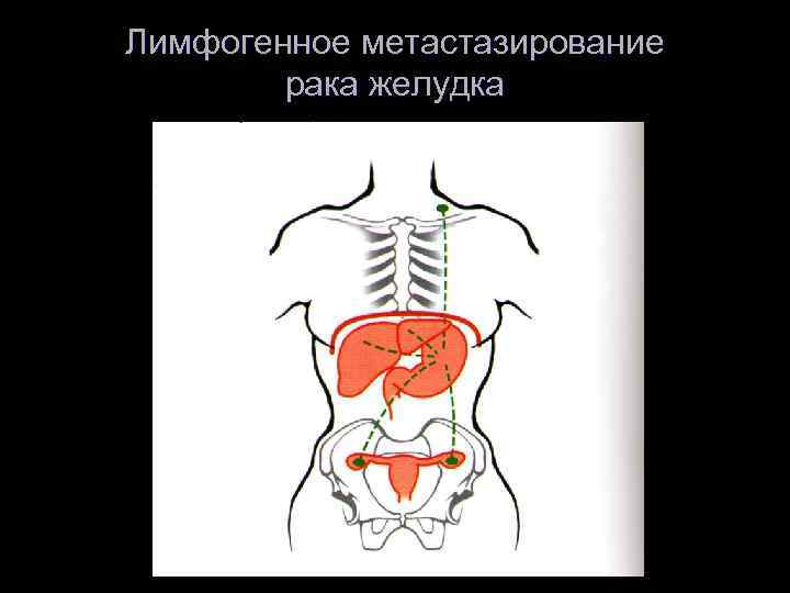 Лимфогенное метастазирование рака желудка 