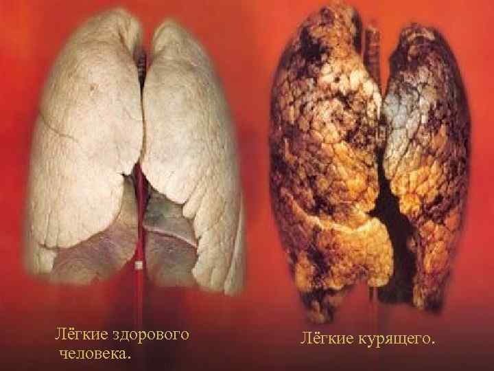 Лёгкие здорового человека. Лёгкие курящего. 