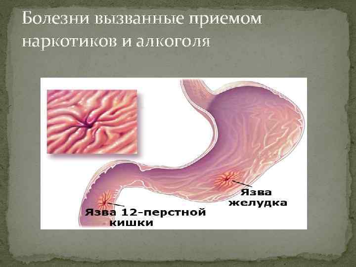 Болезни вызванные приемом наркотиков и алкоголя 