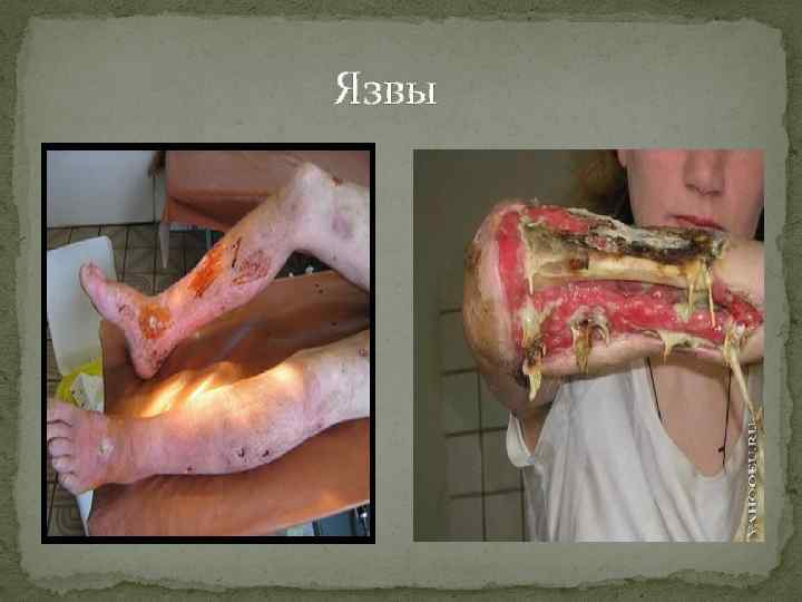 Язвы 
