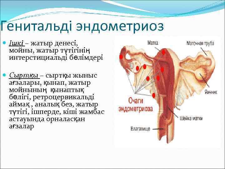 Генитальді эндометриоз Ішкі – жатыр денесі, мойны, жатыр түтігінің интерстициальді бөлімдері Сыртқы – сыртқы