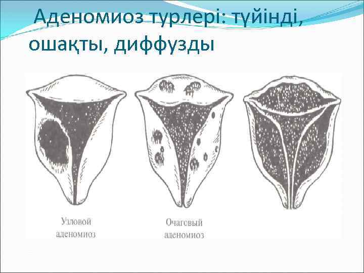 Аденомиоз турлері: түйінді, ошақты, диффузды 