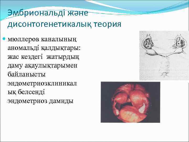 Эмбриональді және дисонтогенетикалық теория мюллеров каналының аномальді қалдықтары: жас кездегі жатырдың даму ақаулықтарымен байланысты