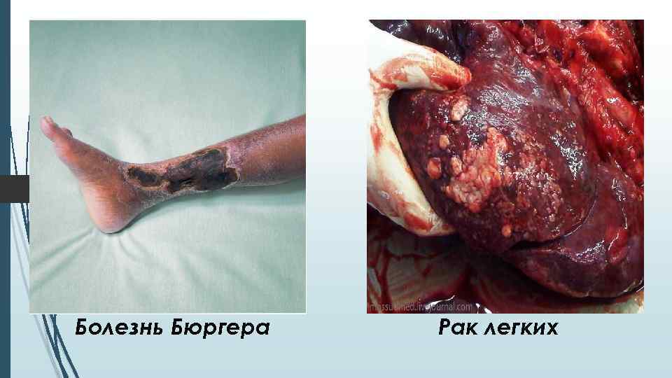 Болезнь Бюргера Рак легких 