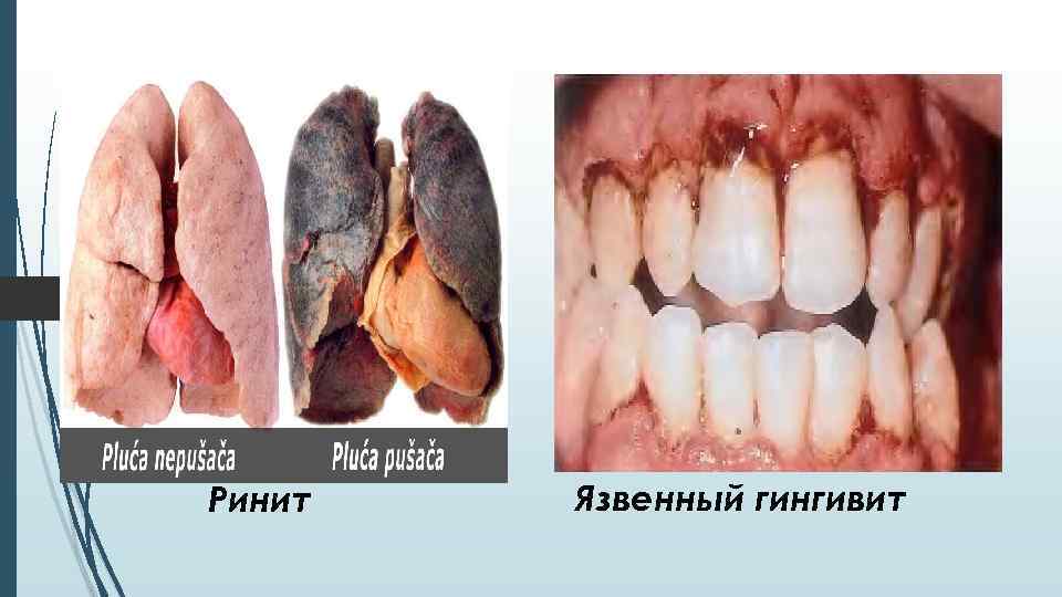 Ринит Язвенный гингивит 
