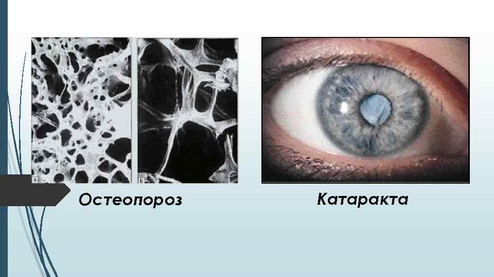 Остеопороз Катаракта 