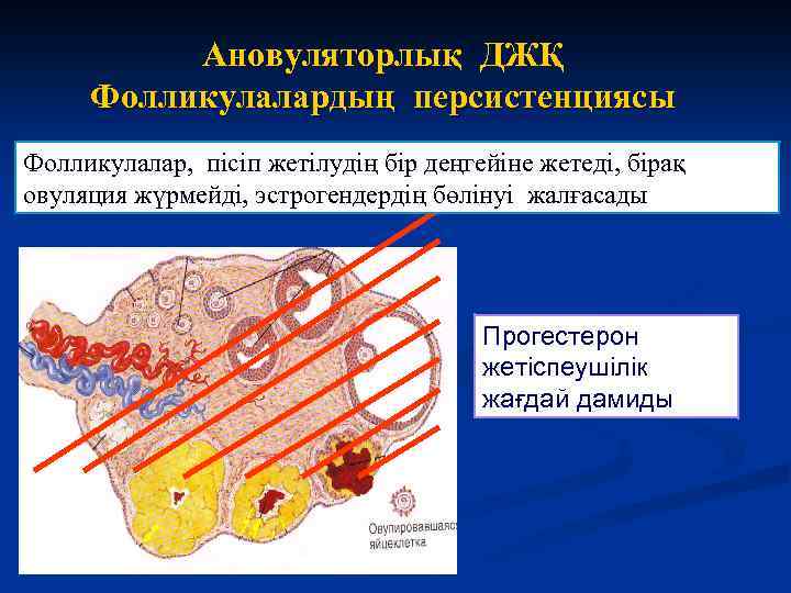 Ановуляторлық ДЖҚ Фолликулалардың персистенциясы Фолликулалар, пісіп жетілудің бір деңгейіне жетеді, бірақ овуляция жүрмейді, эстрогендердің