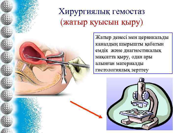 Хирургиялық гемостаз (жатыр қуысын қыру) Жатыр денесі мен цервикальды каналдың шырышты қабатын емдік және