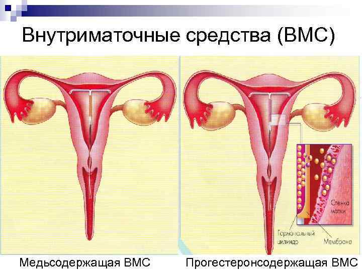 Внутриматочные средства (ВМС) Медьсодержащая ВМС Прогестеронсодержащая ВМС 