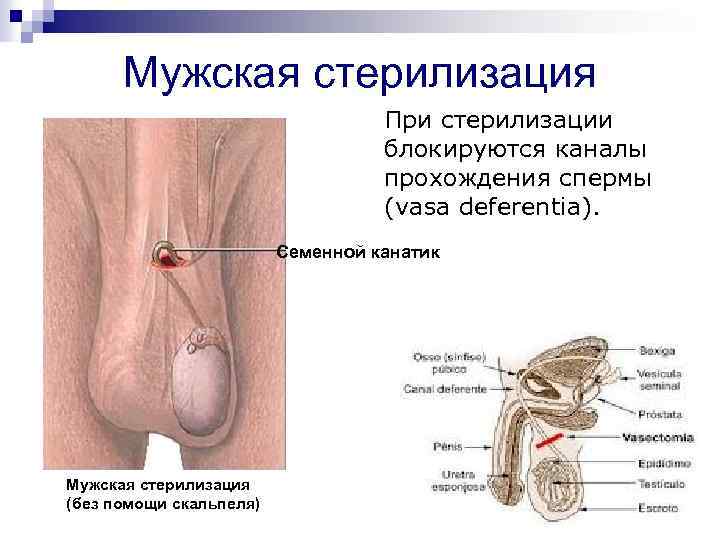 Мужская стерилизация При стерилизации блокируются каналы прохождения спермы (vasa deferentia). Семенной канатик Мужская стерилизация