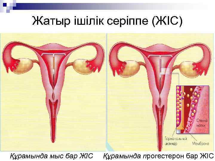 Жатыр ішілік серіппе (ЖІС) Құрамында мыс бар ЖІС Құрамында прогестерон бар ЖІС 