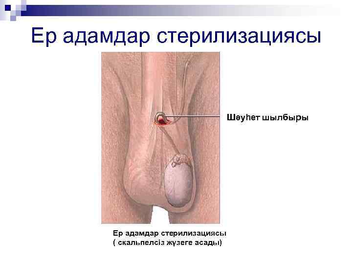 Ер адамдар стерилизациясы Шәуһет шылбыры Ер адамдар стерилизациясы ( скальпелсіз жүзеге асады) 