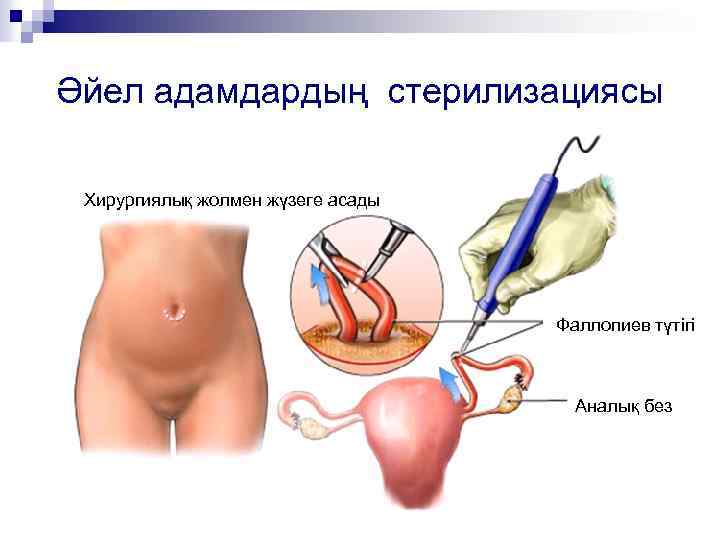 Әйел адамдардың стерилизациясы Хирургиялық жолмен жүзеге асады Фаллопиев түтігі Аналық без 